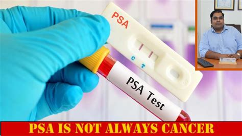 Prostate Cancer Screening With The PSA Test Justinboey