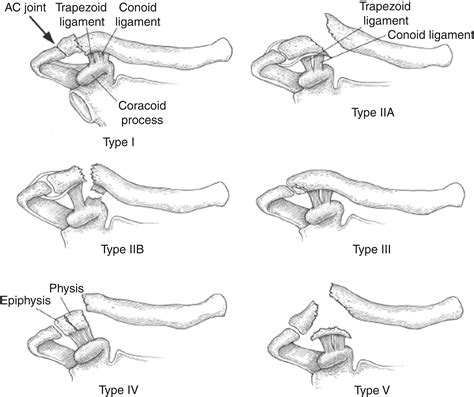 Distal Clavicle Fractures Clinical Tree