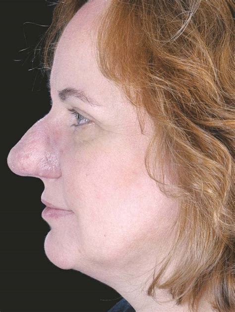 Coping With RHINOPHYMA Read This Story On Magzter