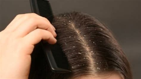 Easy Ways To Get Rid Of Dandruff Health Hindustan Times