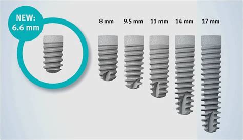 The latest product news from DENTSPLY Implants – the new powerhouse in ...