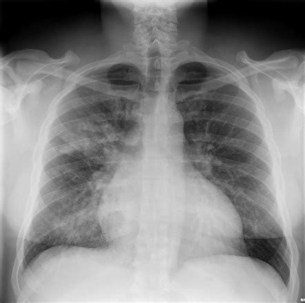 Chest X Ray Bronchitis Vs Pneumonia