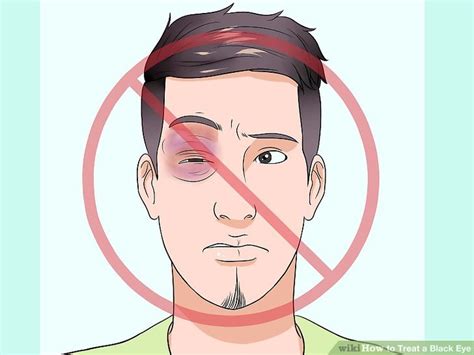 3 Ways to Treat a Black Eye - wikiHow