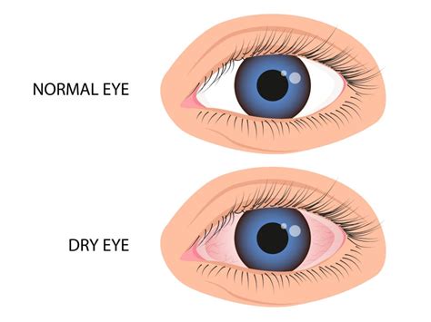 What Is Dry Eye Syndrome Causes Symptoms More