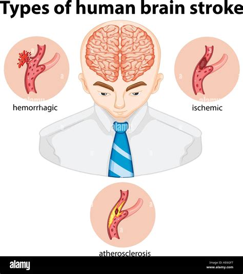 Types Of Human Brian Stroke Illustration Stock Vector Image Art Alamy