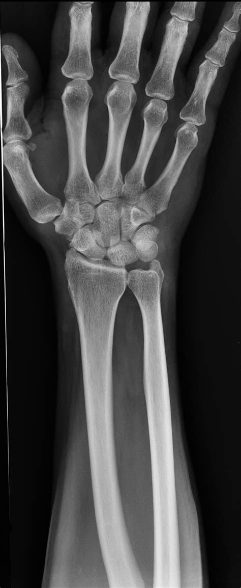 Triquetral Fracture Image