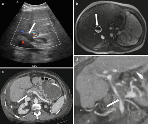 Imaging Of Liver Transplant Radiology Key