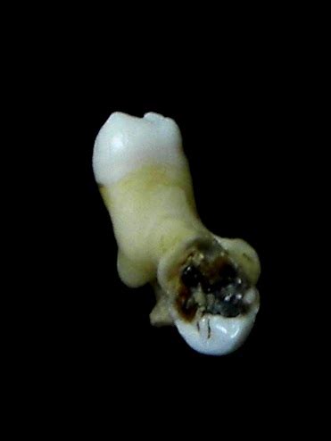 Deformutilation: Concrescence - Tooth Fusion