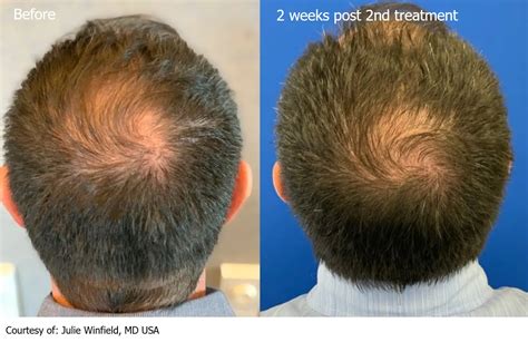 Keralase Hair Restoration Tampa Bay Laser