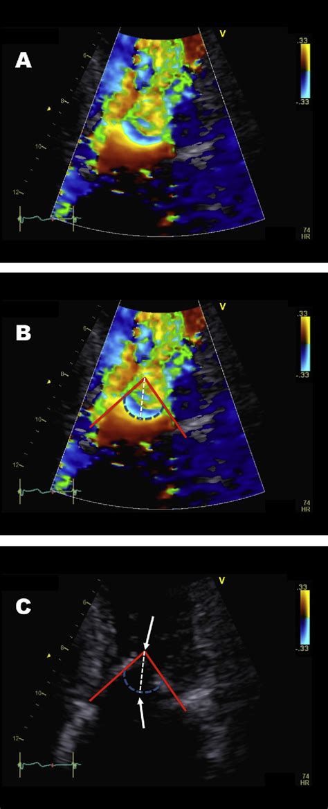 Figure From Radius Of Proximal Isovelocity Surface Area In The