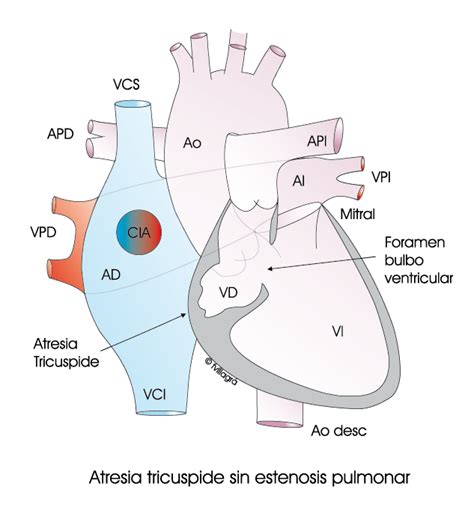 Ventrículo Único Atresia Tricúspide Atresia Mitral Ventrículo Único