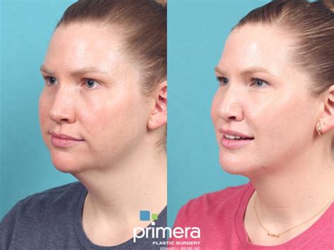 Submentoplasty Chin Tuck Before And After Photo Gallery Orlando And Tampa Florida Primera