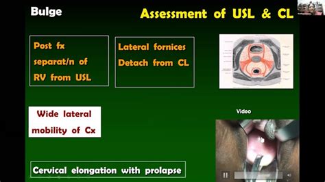 Pelvic Organ Prolapse Pop Q In Puga Session By Dr Rajamaheswari India Youtube