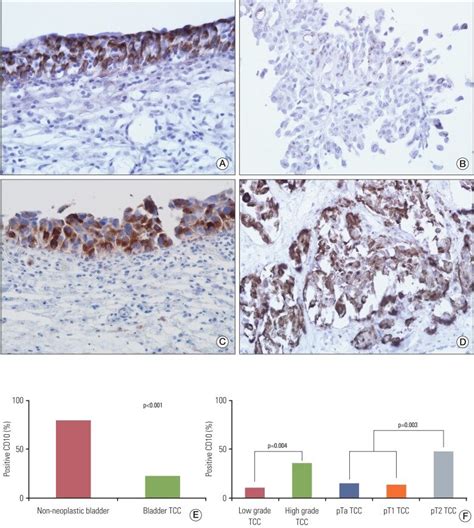 A CD10 In Non Neoplastic Urothelium B Non Invasive Low Grade