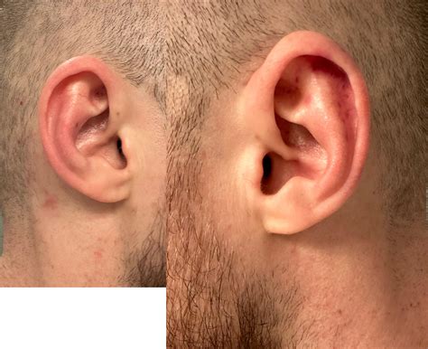 Early Stages Of Cauliflower Ear R Wrestling