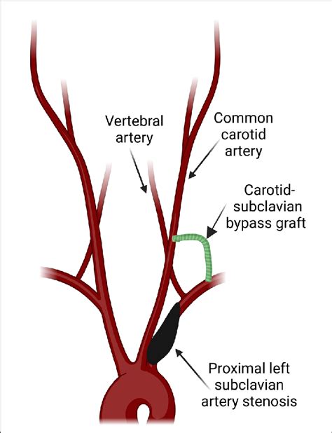 Graphic Illustrates A Carotid Subclavian Bypass Graft Created With Download Scientific Diagram