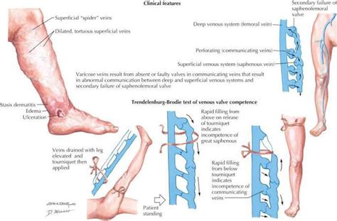 Trendelenburg Test For Varicose Veins Medizzy