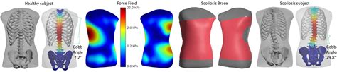 A Study Of The Sensitivity Of Biomechanical Models Of The Spine For