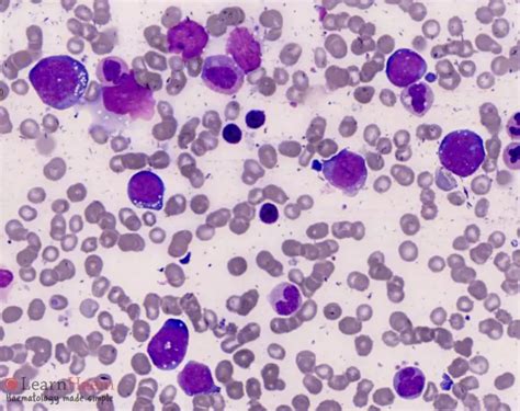 Burkitt Lymphoma Learnhaem Haematology Made Simple