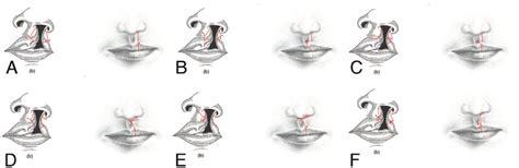 Trends In Unilateral Cleft Lip Repair Approaches A Rose Thompson Download Scientific