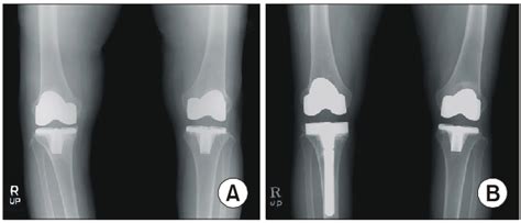 Image Showing Tibial Aseptic Loosening Of The Right Knee 3 Years After Download Scientific