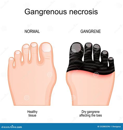 Gangrene Affecting The Toes Tissue Death By Gangrenous Necrosis Stock Vector Illustration Of