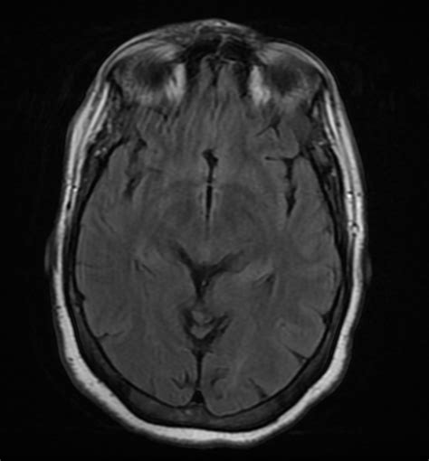 Meningioma Frontal Convexity Image