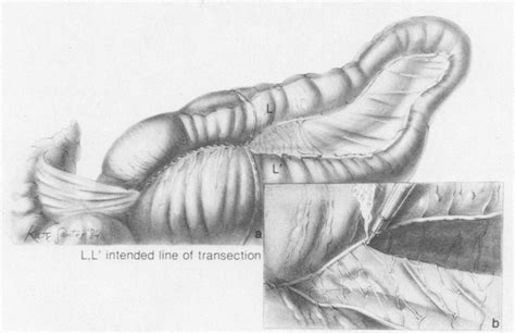 A Cecum And Large Colon With Intended Line Of Transection L L Shown Download Scientific