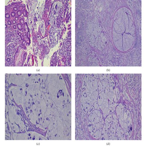 Figure 1 From Mucinous Colorectal Carcinoma In A 17 Year Old Male A