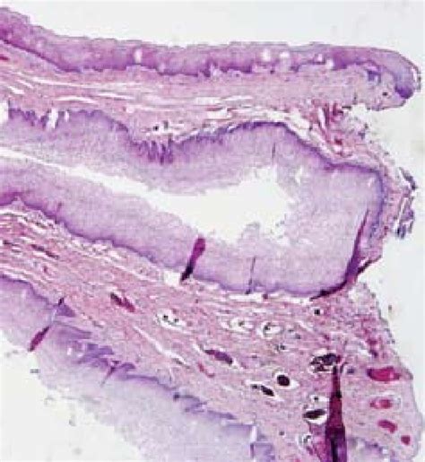 Base And Tip Of Polyp Fibrovascular Stroma Covered With Stratified