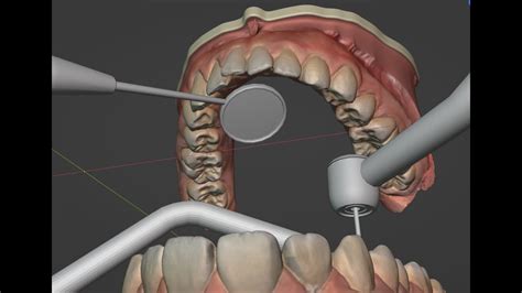 Instruments Positioning For Indirect Vision Maxillary Premolar Crown Preparation Under