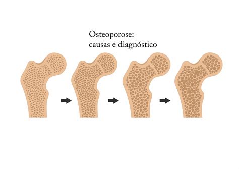 Osteoporose Primaria E Secundaria Edukita