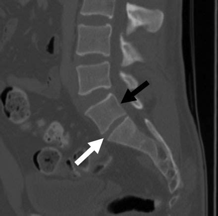 lss transitional  vertebral body sagittal ct image demonstrates
