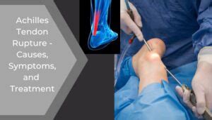 Achilles Tendon Rupture Causes Symptoms And Treatment Dr Omar Sabri