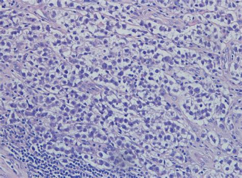 Testicular Involvement By Mixed Germ Cell Neoplasm Associated With Germ Download Scientific