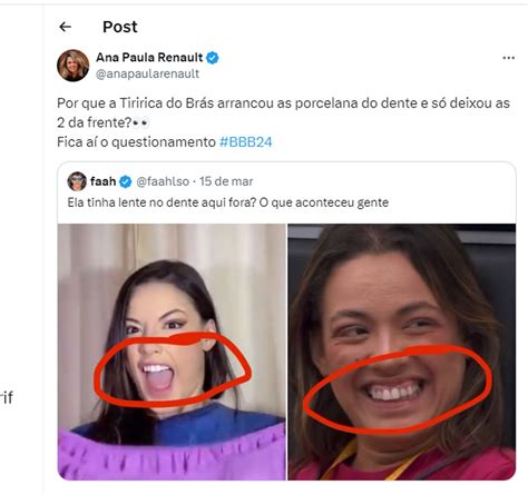 Beatriz tirou as lentes dos dentes antes de entrar no BBB 24 Irmão