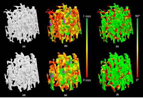 Figure From Quantitative Imaging Of Peripheral Trabecular Bone