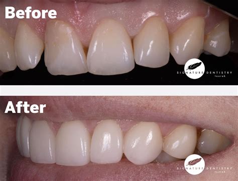 Veneers Before and After By Dr Kasen