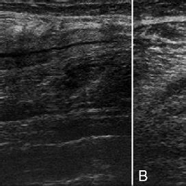 A B Case 2 Extended Field Of View Longitudinal A And Transverse