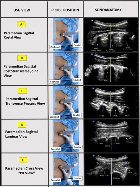 Real Time Ultrasound Guided Mid Thoracic Epidural Access Using A Novel Paramedian Cross Px