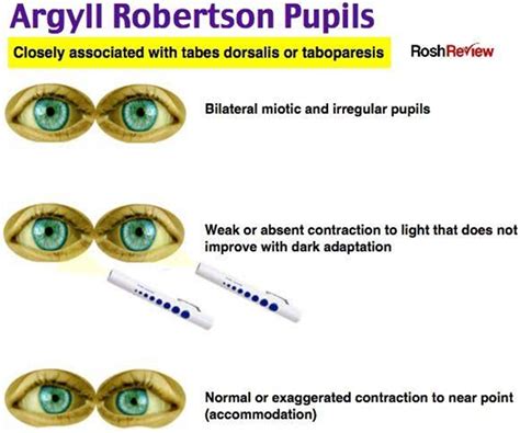Abnormal Pupils