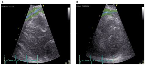 Jcm Free Full Text Association Of Cardiovascular Health With Epicardial Adipose Tissue And