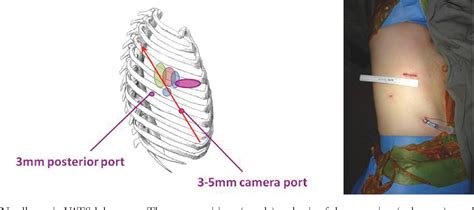 Figure From The Evolution Of Minimally Invasive Thoracic Surgery