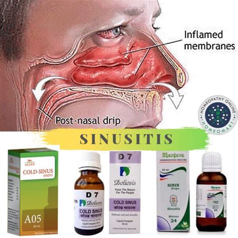 Homeopathy For Post Nasal Drip