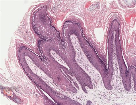 Differential Diagnosis In Dermatopathology Pale Cells In The Epidermis