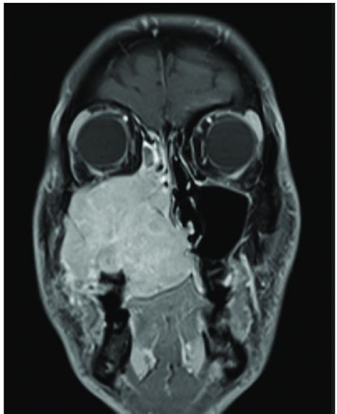 preoperative magnetic resonance imaging mri coronal view