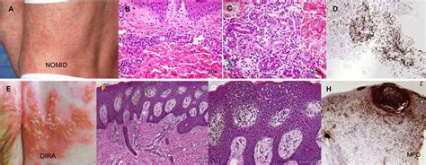 Cutaneous Manifestations And Dermatopathology Of Nomid A Through D