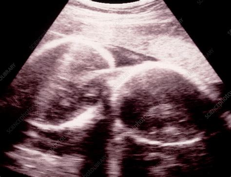 Identical Twins Ultrasound 20 Weeks