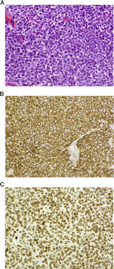 Rare Presentation Of Ewing Sarcoma Metastasis To The Sella And