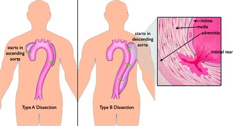 Aortic Dissection Circulation